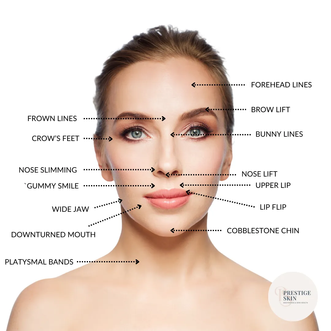 Close-up of a Botox® injection about to be administered to the forehead at Prestige Skin Cambridge