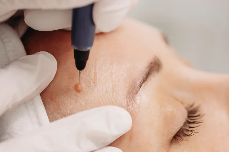 Sterile electrolysis probe targeting a skin tag during lesion removal treatment in Cambridge