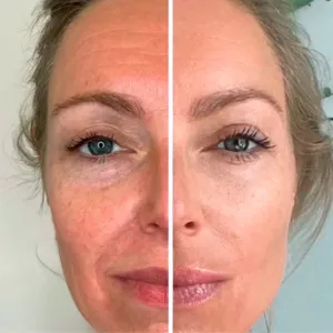 Sunekos full-face before and after showing improved skin hydration and a fresher, more radiant complexion