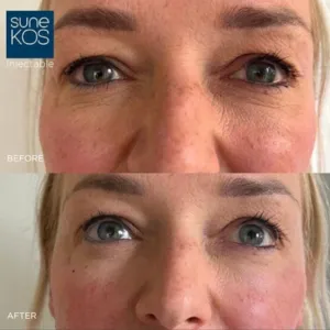 Sunekos before and after on a client in her early 40s, showing softer fine lines and firmer skin around the eyes and cheeks