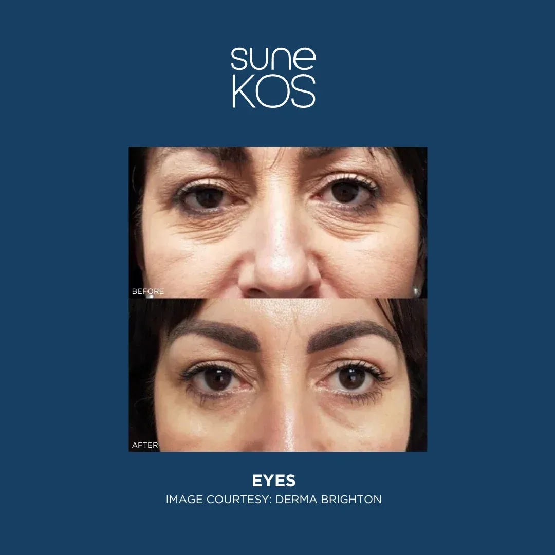 Sunekos full-face before and after showing improved skin hydration and a fresher, more radiant complexion