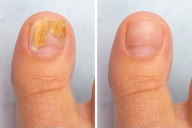 Mycosyn Pro Nail Fungus