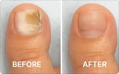 Blinzador Antifungal Spray 