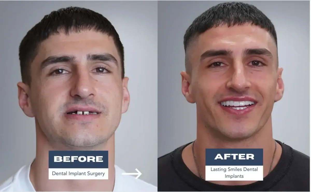 Dental Implant Before and After Photo