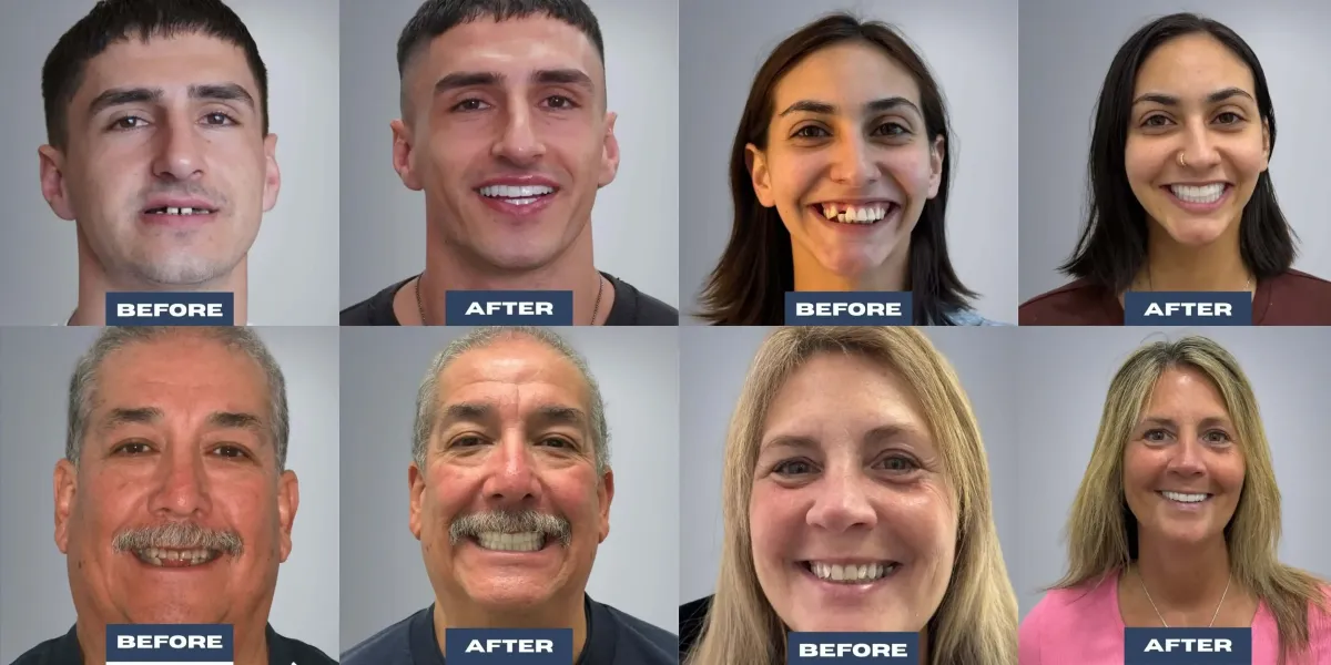 Dental Implant Real Patients of Lasting Smiles