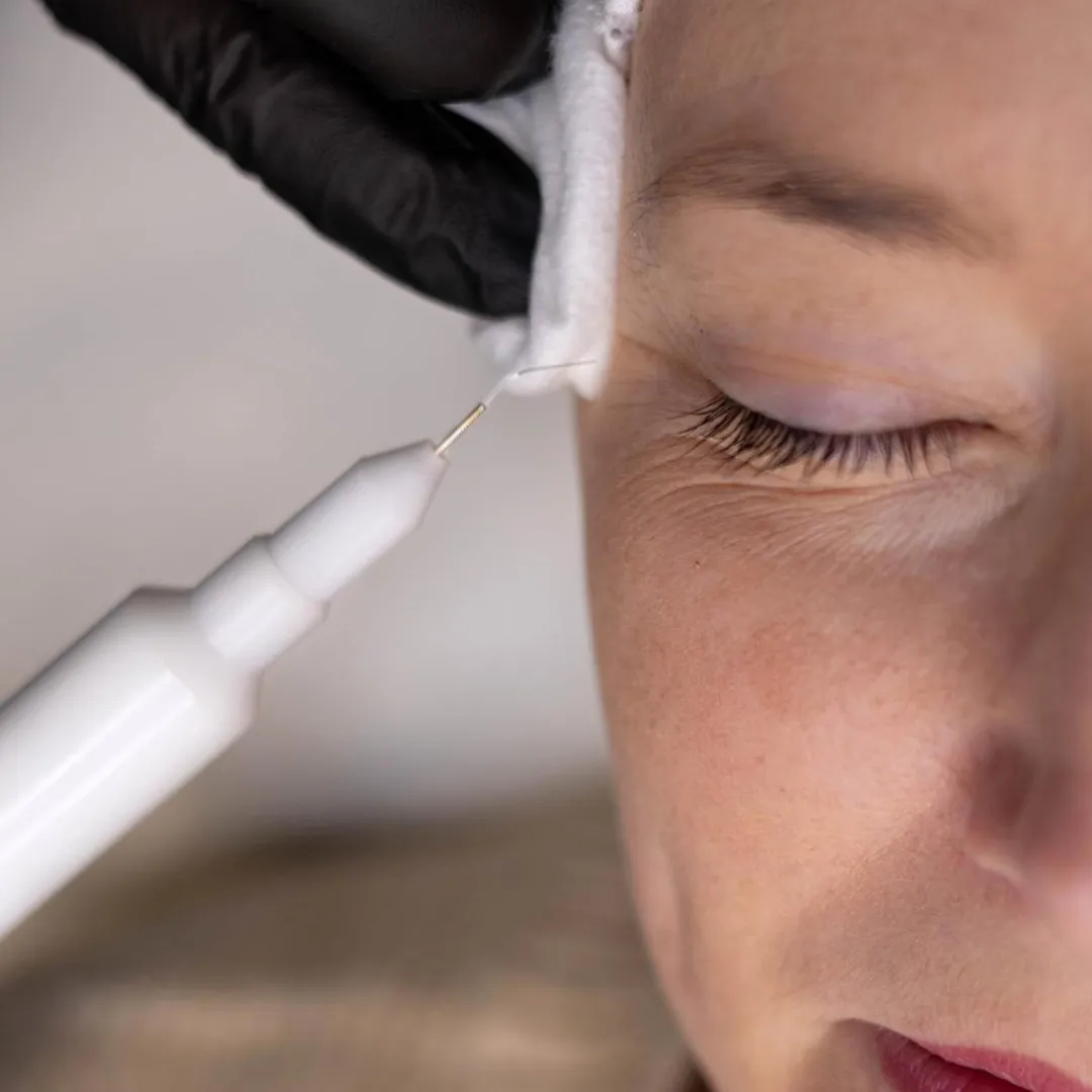 Agrandissement sur un soin visage plasma lift réaliser à Cherbourg