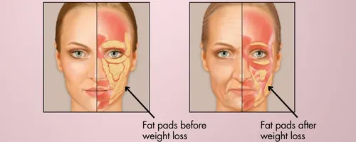 Two women, one with fat pad before weight loss and another with less fat pads after weight loss