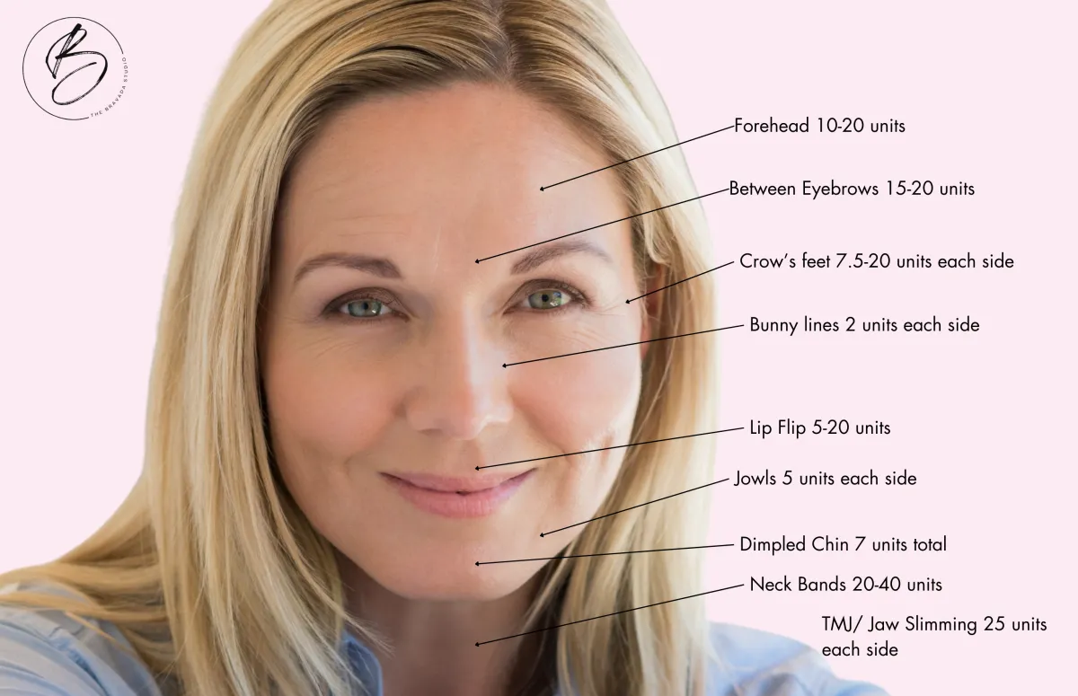 Woman with aorrws and labeled areas for Botox placement