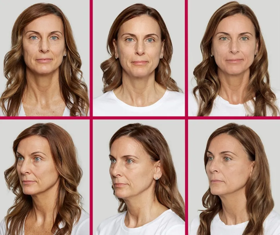 Why Sculptra Is a Beautifully Summer-Friendly Treatment