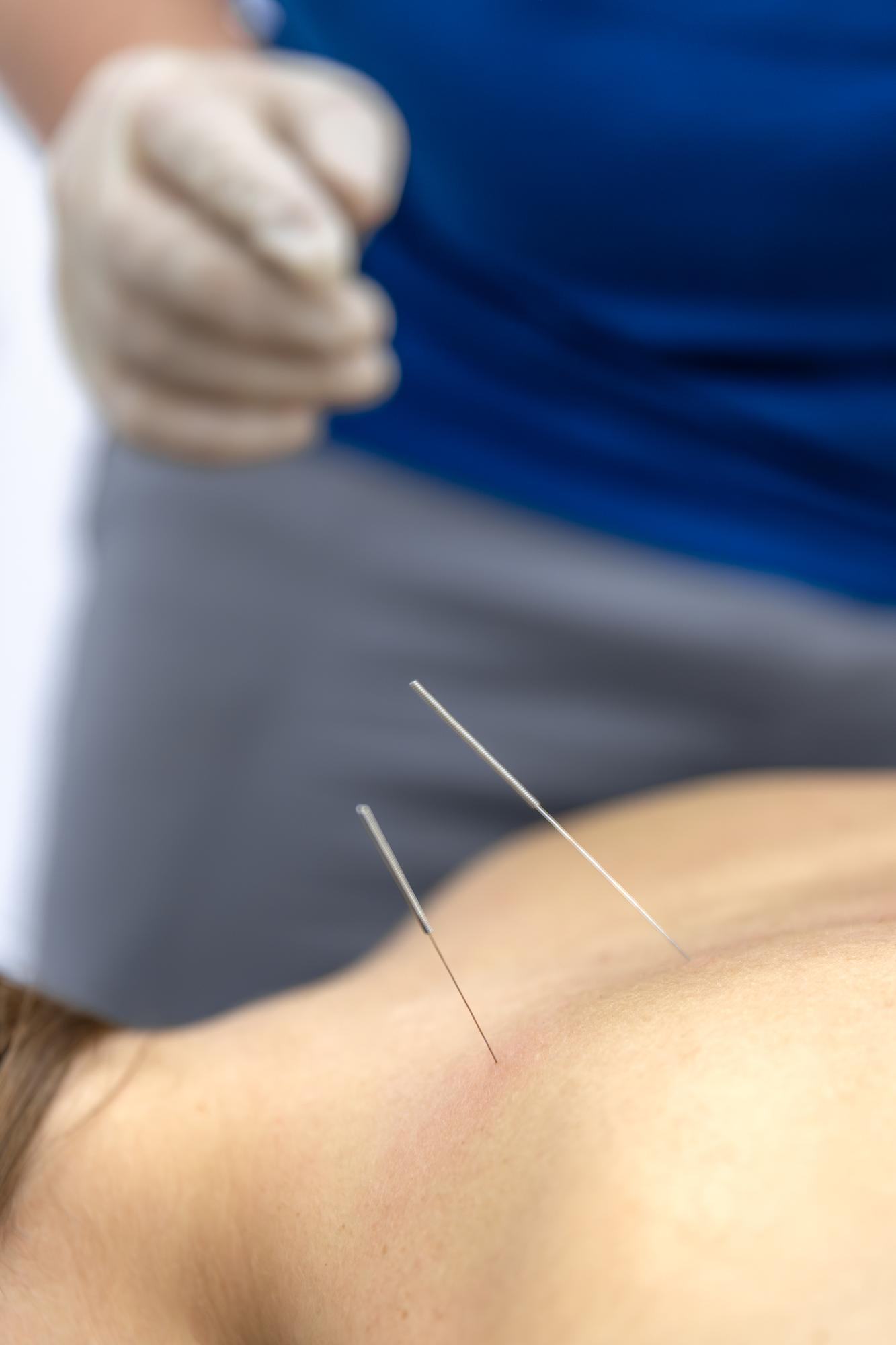 Dry Needling in Huntsville, Alabama