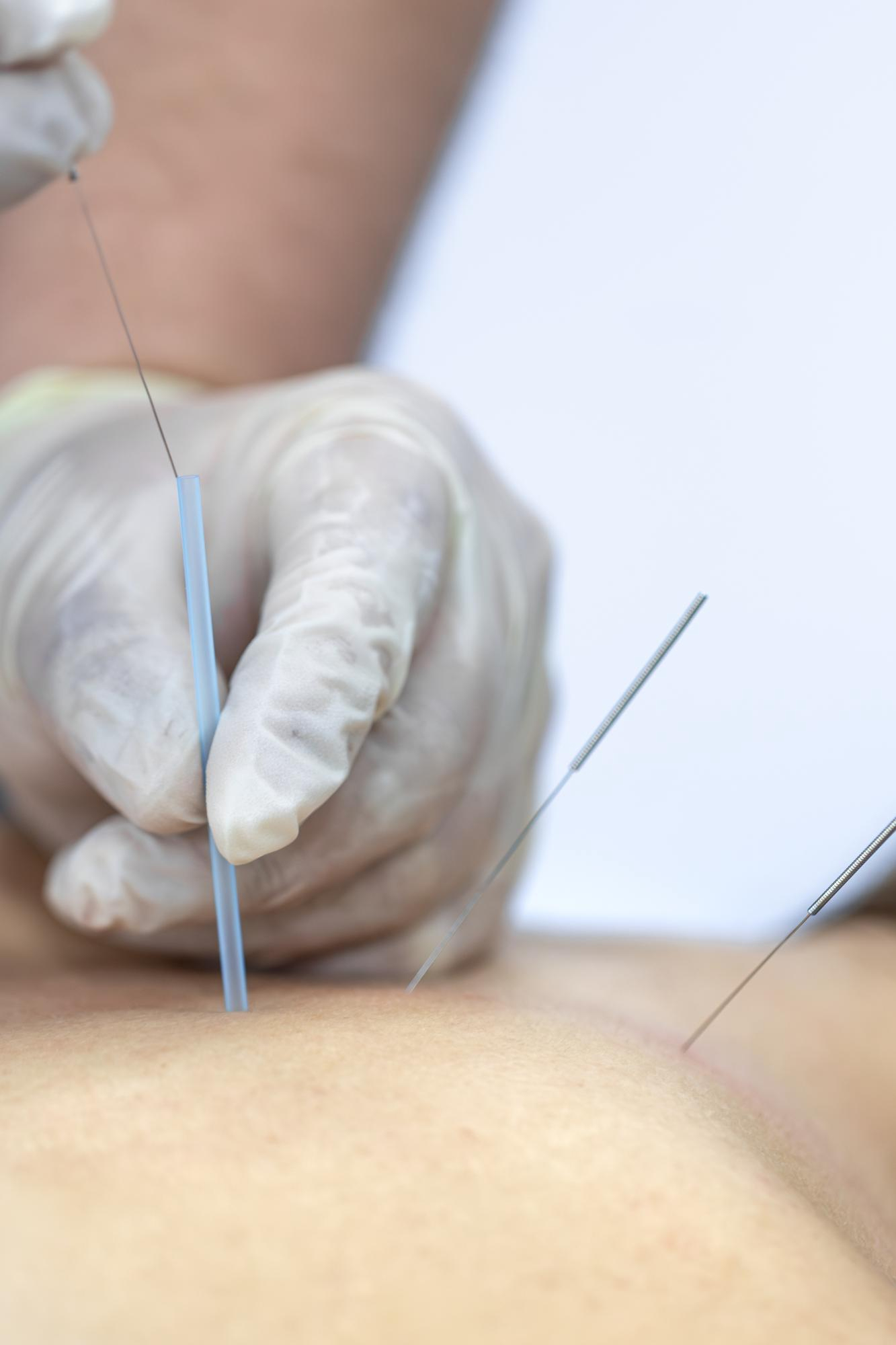Dry Needling in Huntsville, Alabama