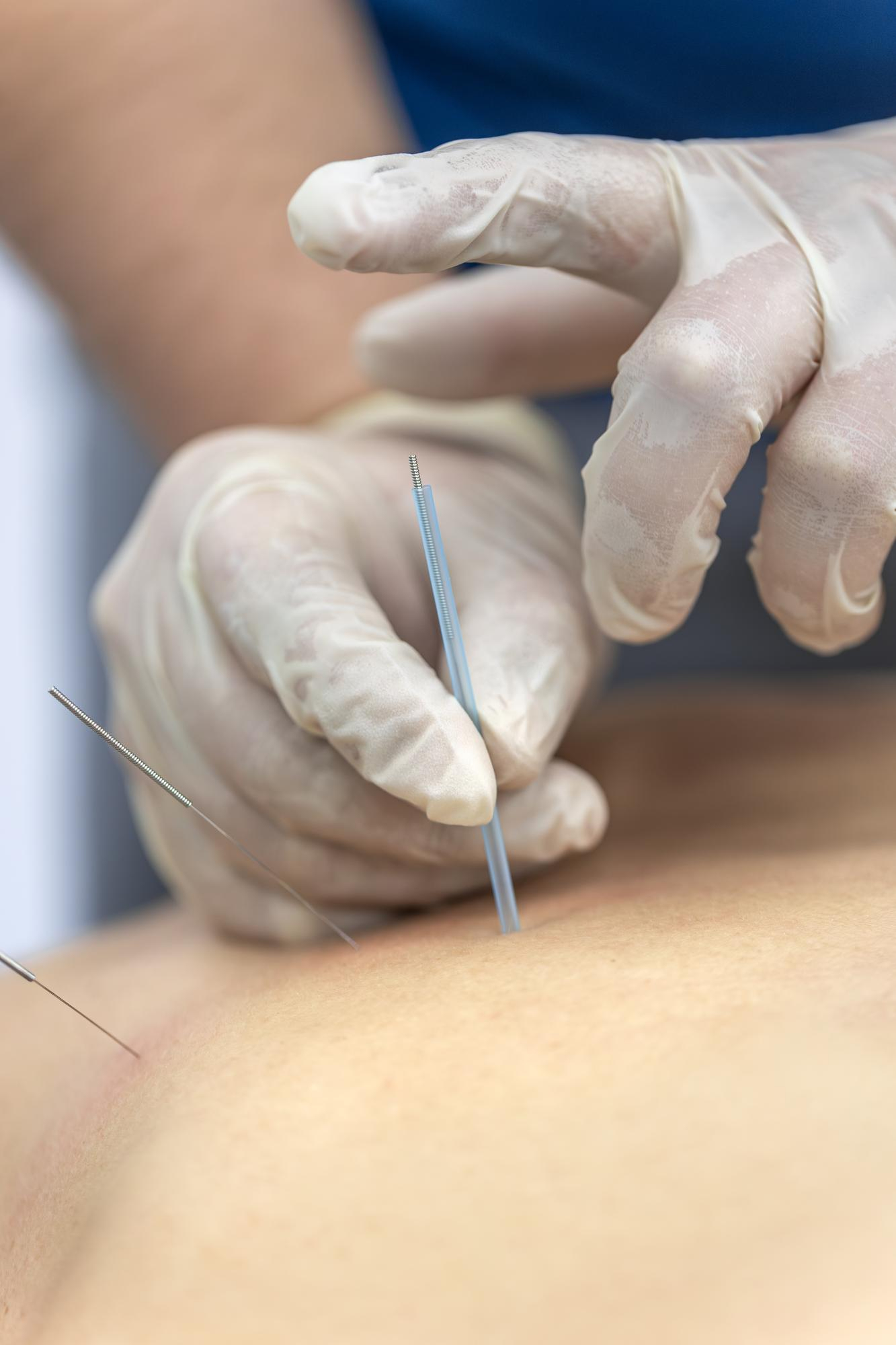 Dry Needling in Huntsville, Alabama