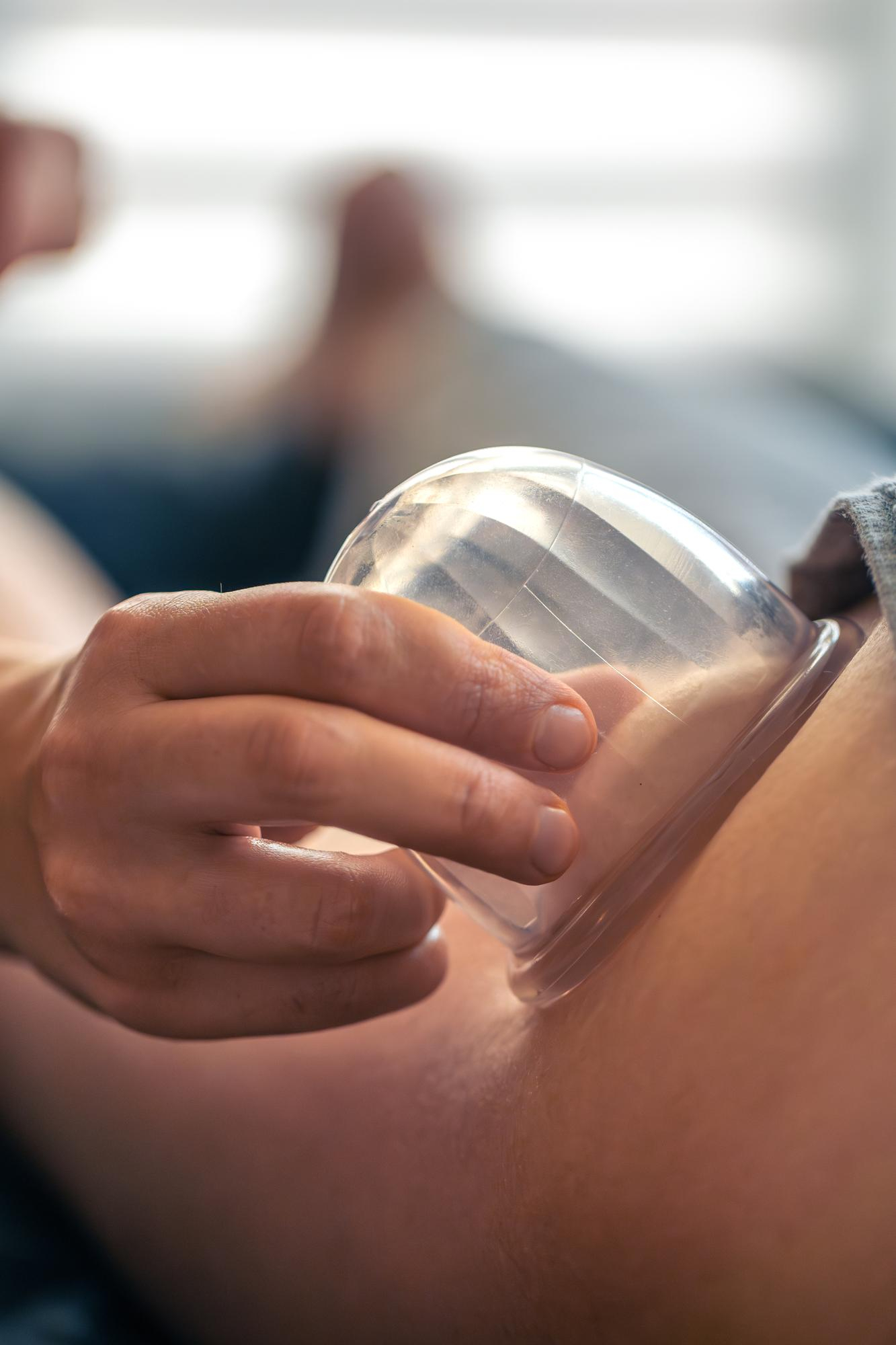 Cupping Therapy in Huntsville, Alabama