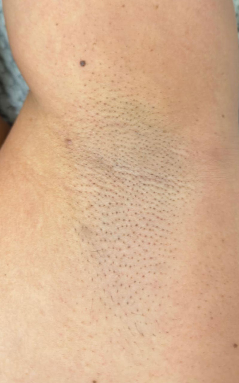Underarm lightening at Lilis Skin Care