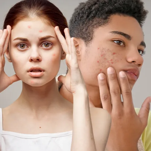 Teens can experience many different types of concerns when it comes to their skin