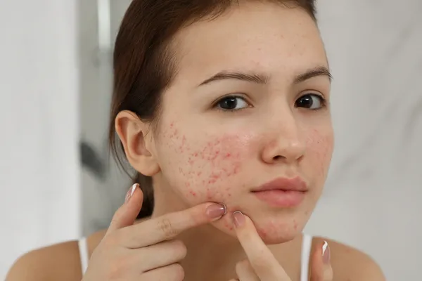 Teens can experience many different types of concerns when it comes to their skin, The Treatment Rooms Essex can help!