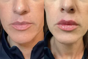 Facial treatment before and after - side view