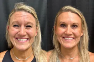 Facial treatment before and after - profile view
