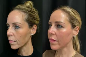Facial treatment before and after - front view