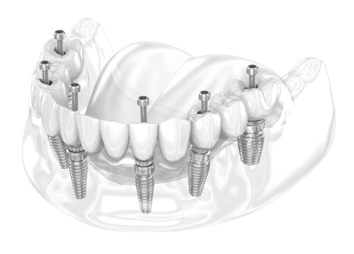 Dental Implant Diagram