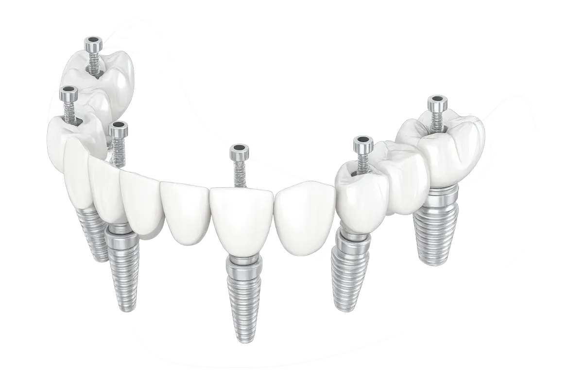 Dental Implant 