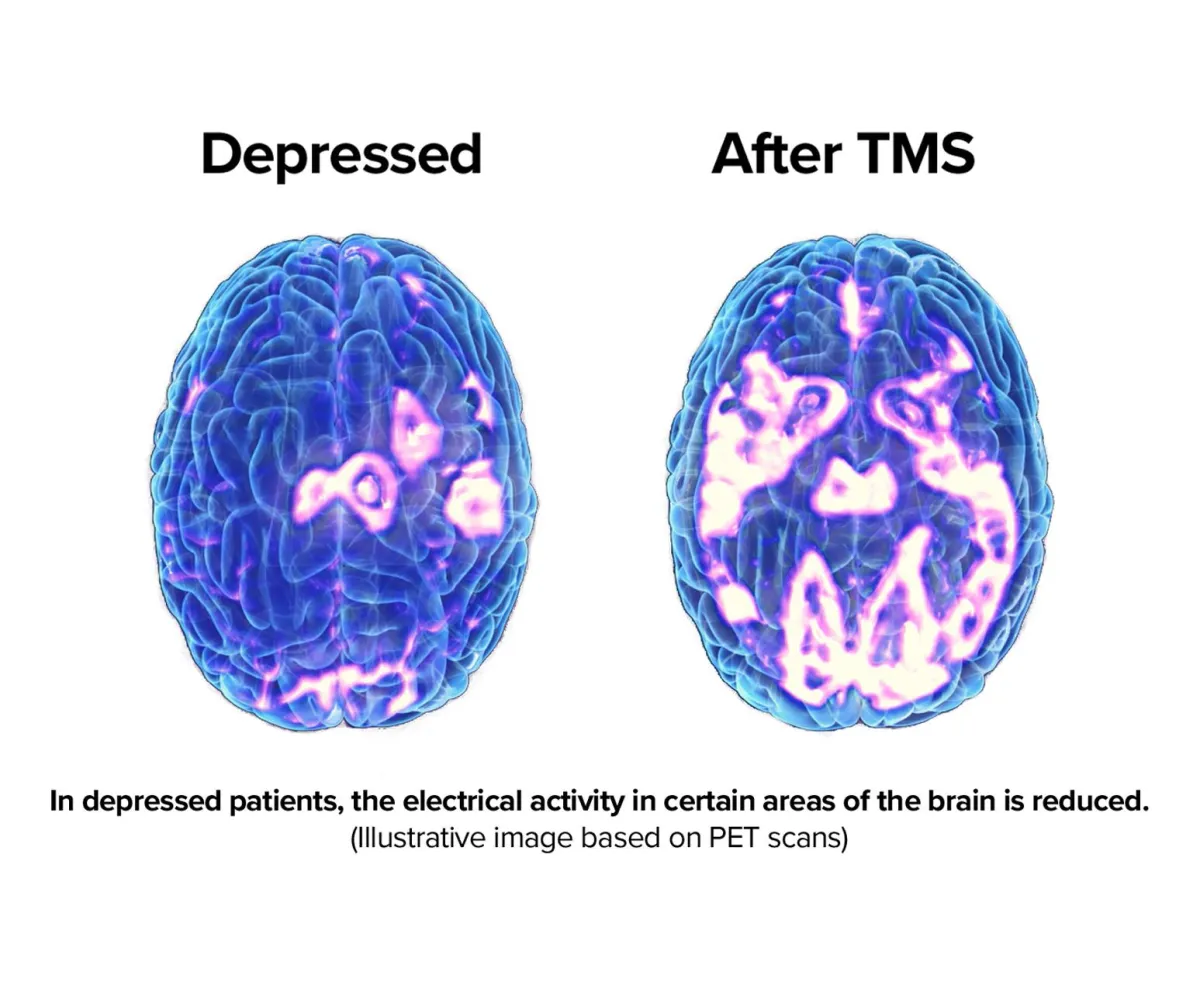 Learn About TMS Brain | Paradise Behavioral Health