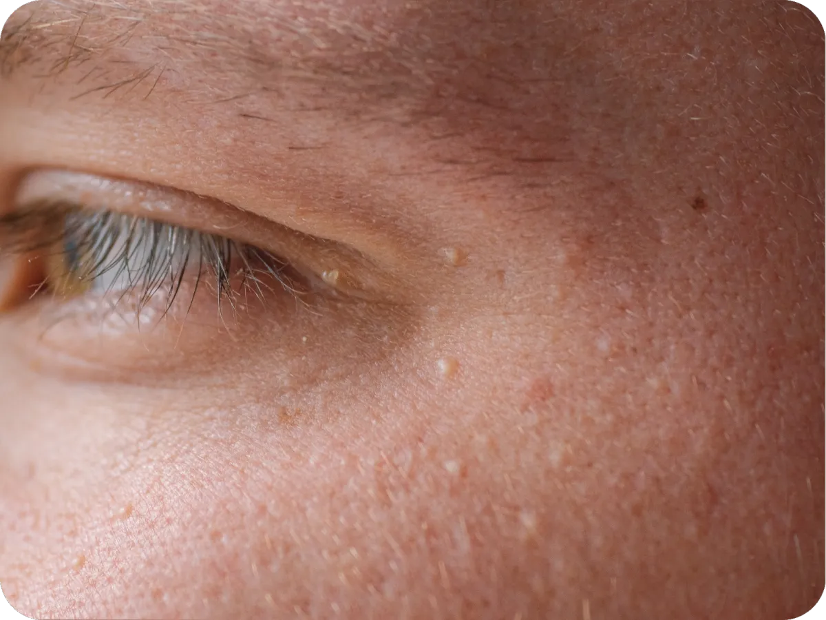 HBOT_OXYHGEN _THERAPY_LONG_COVID_TREATMENT_BRISTOL