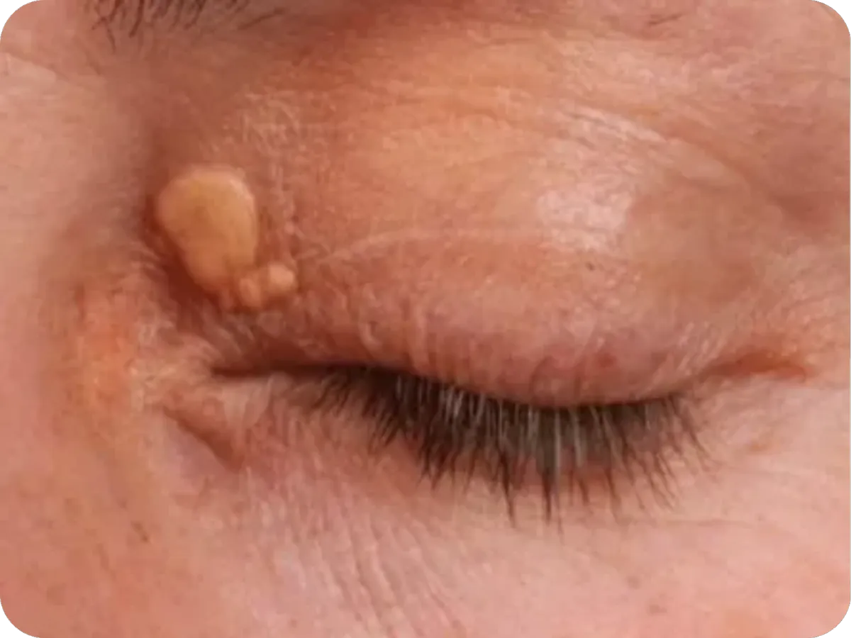 HBOT_HEALING_POST_SURGERY_OXYGEN_BRISTOL