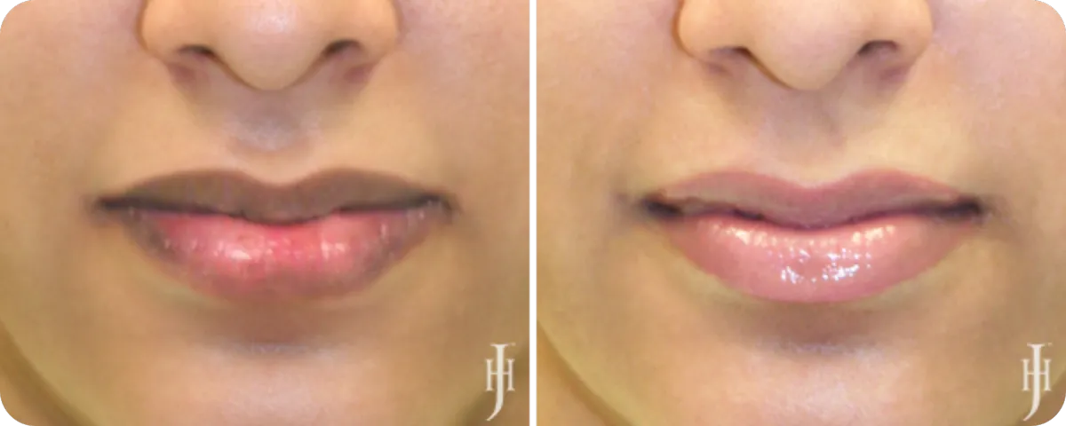 HBOT_HEALING_POST_SURGERY_OXYGEN_BRISTOL