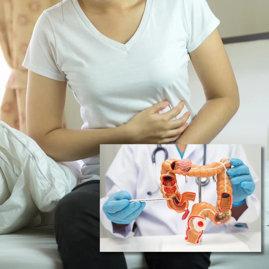 IBS VA Rating Explained for Veterans | How to Qualify & File Stronger Claims