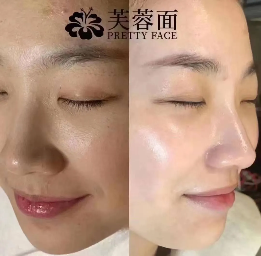 水光针护理 mesotherapy facial