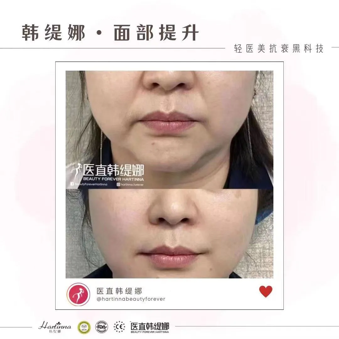 Vshape face treatent