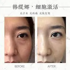 Eyebag remove, dark circle