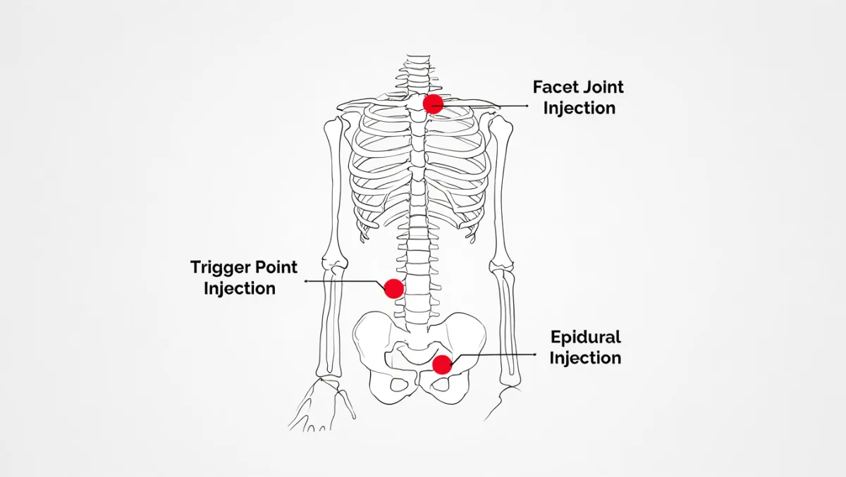 Joint Injection Types and injection site locations with red dots on a skeleton showing injection spots