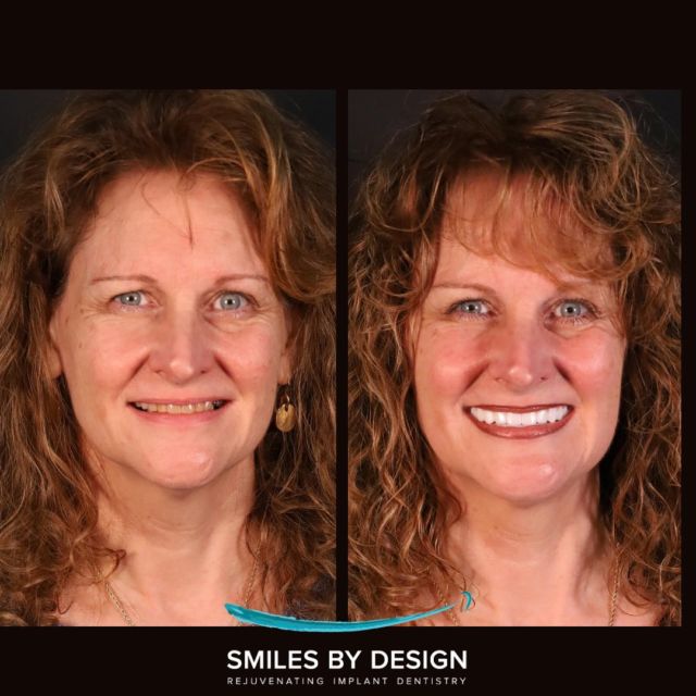 Smile Makeovers