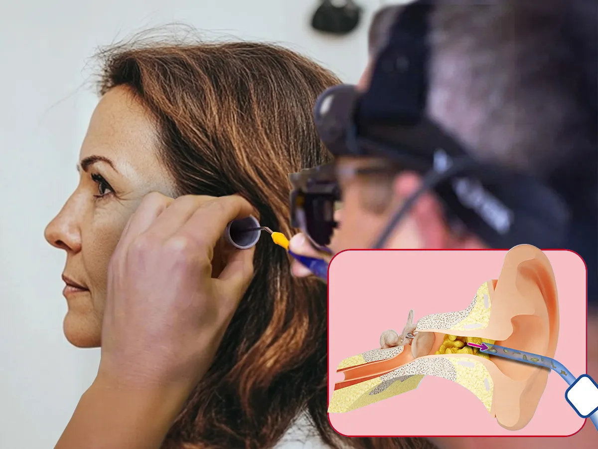 What is microsuction earwax removal?