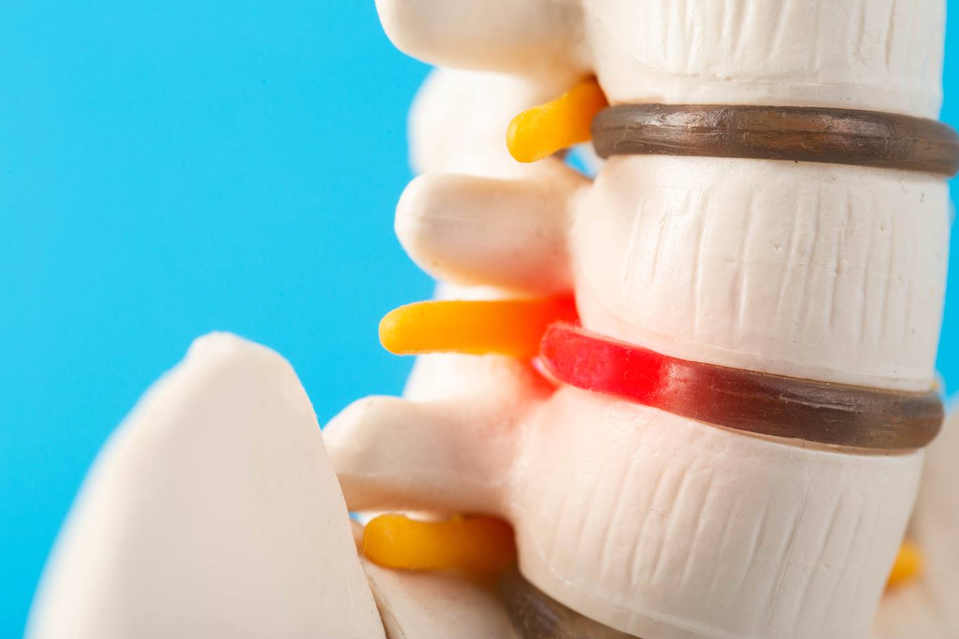 Close up 3D medical illustration of spinal discs showing a herniated disc pressing on a nerve root (glowing red)