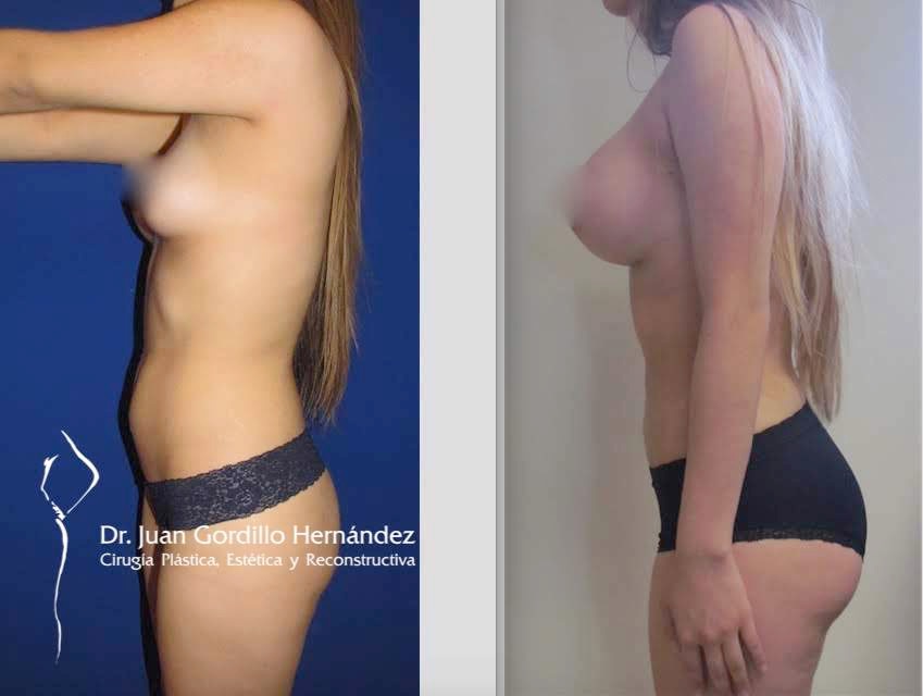 Paciente masculino antes y después de corrección de ginecomastia