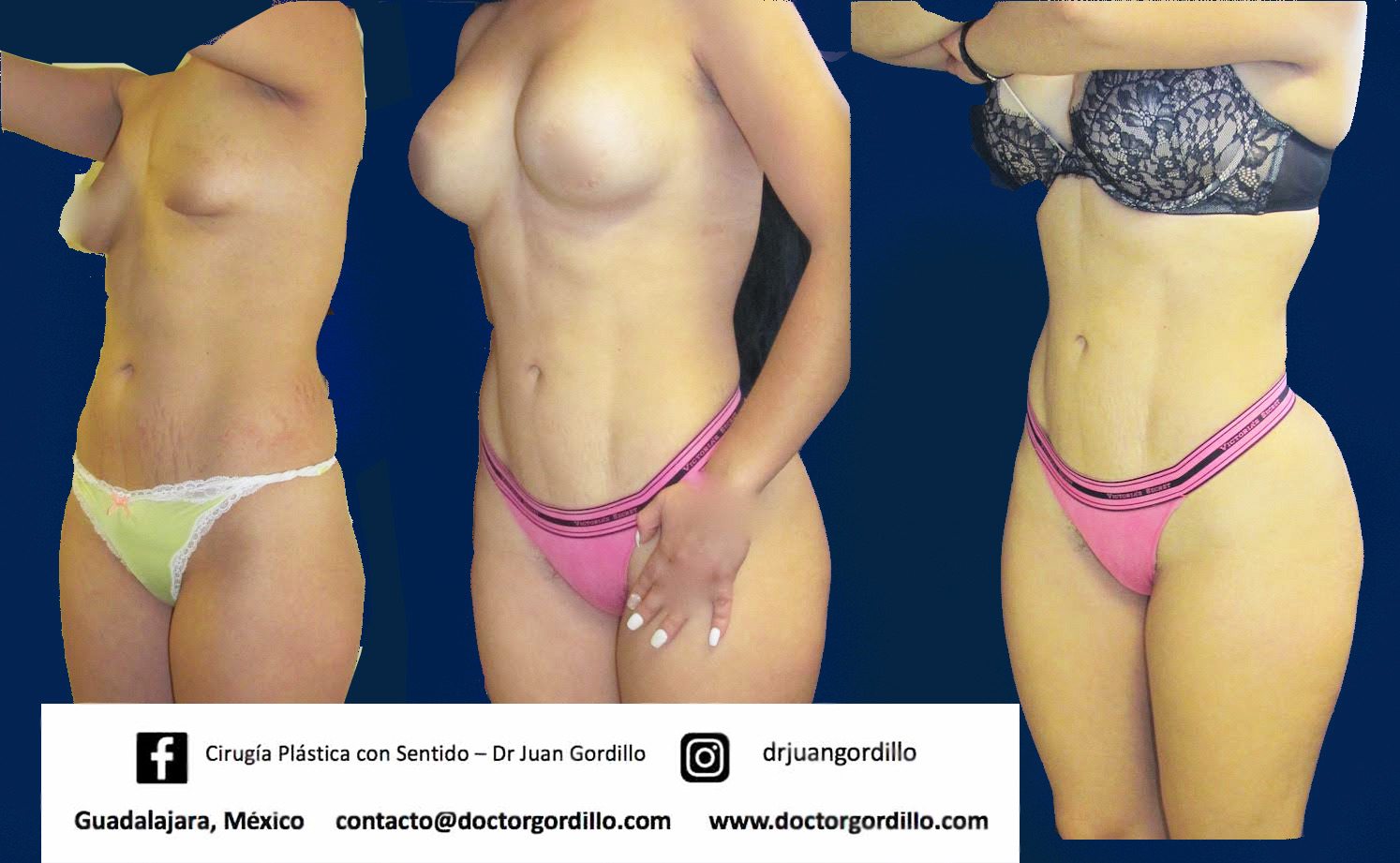 Resultados antes y después de ginecomastia