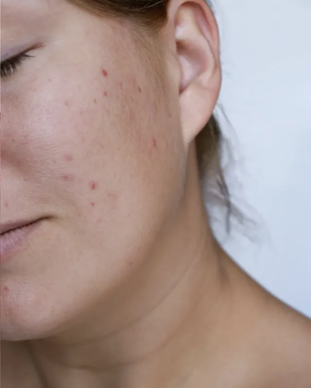 Best Treatments for Acne
