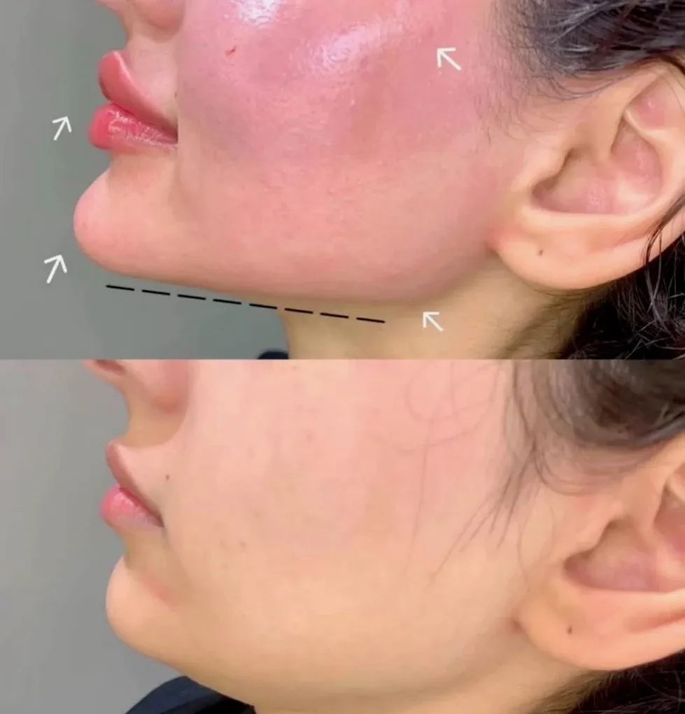 Detailed close-up profile showing sharp jawline contour and refined lower-face definition with bright high-key lighting