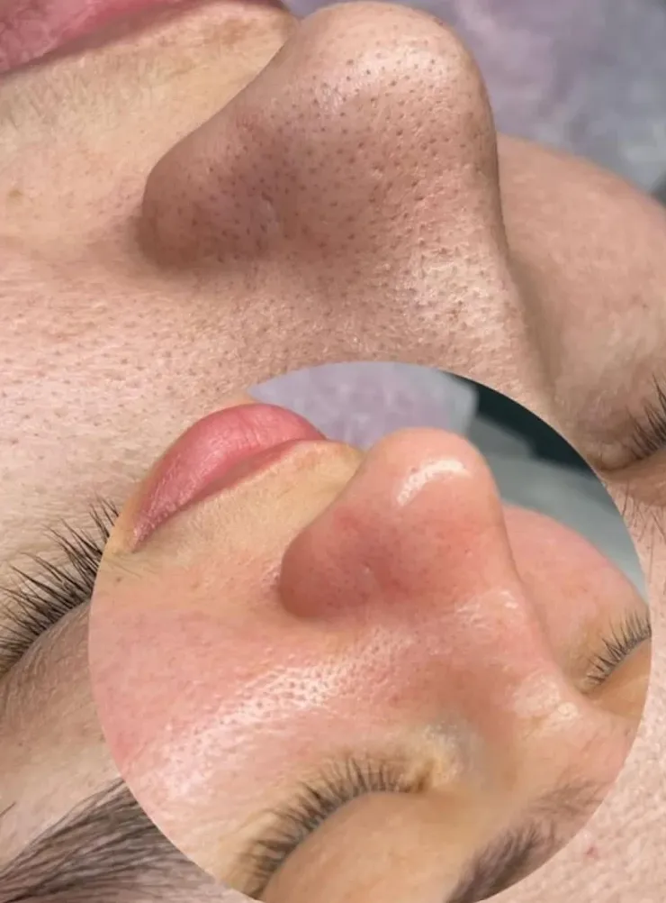 Clinical facial rejuvenation outcome demonstrating natural symmetry and smooth cheek contour under studio daylight