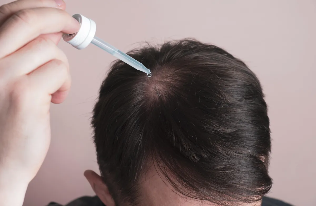 Person applying topical hair regrowth solution to thinning scalp, illustrating non-invasive treatment for hair restoration.