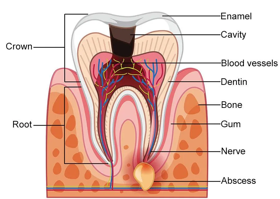 Tooth Abscess