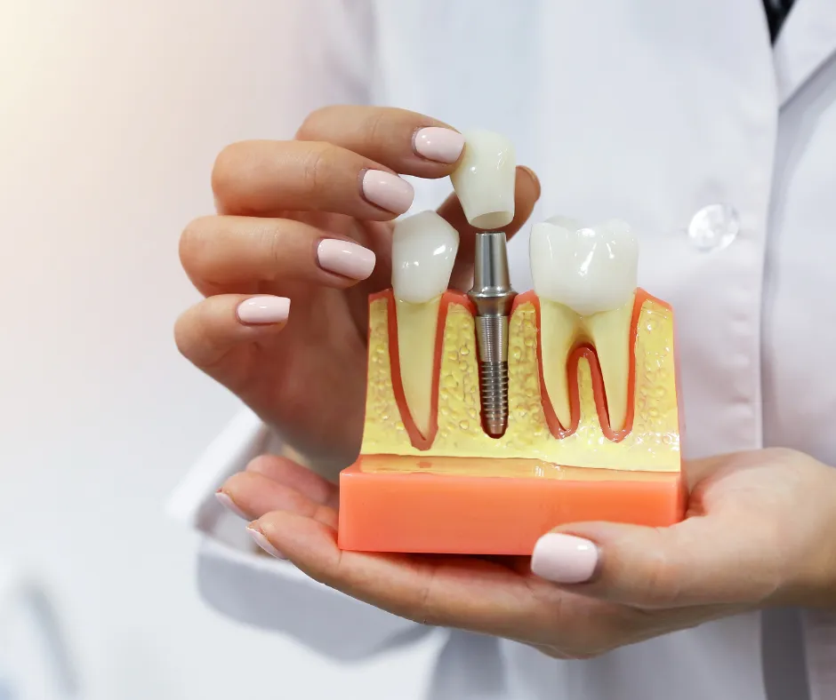 Dental Implants in Kitchener