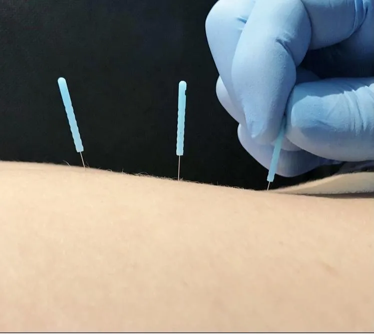 dry needling back