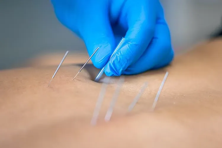 dry needling back