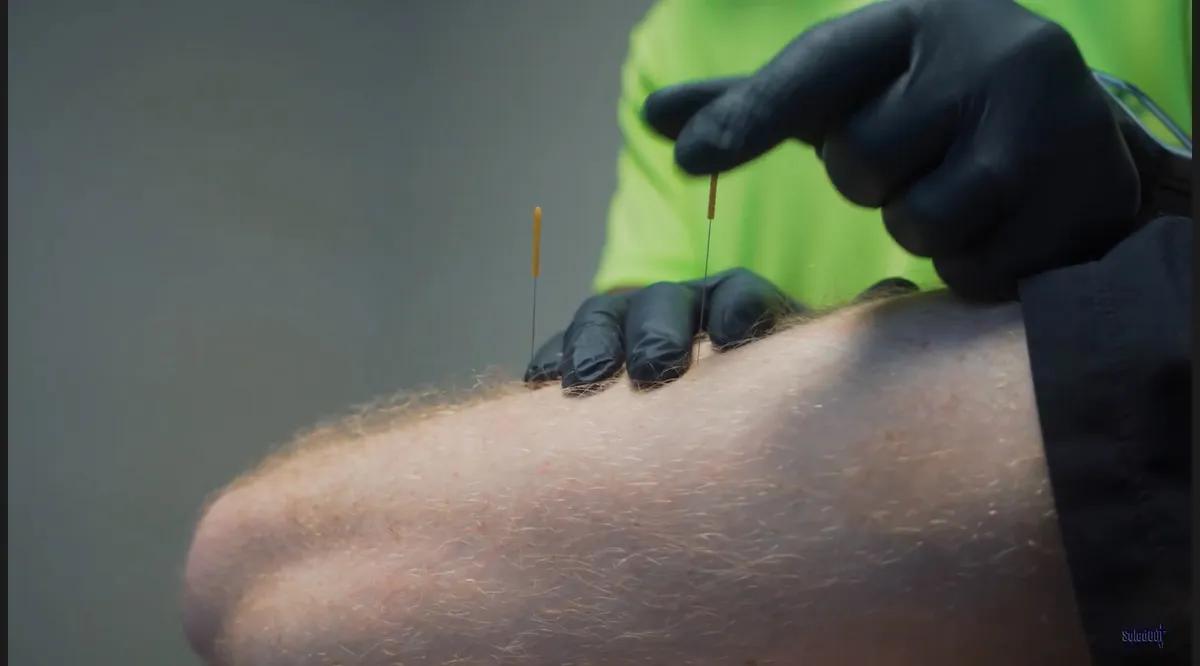 dry needling back