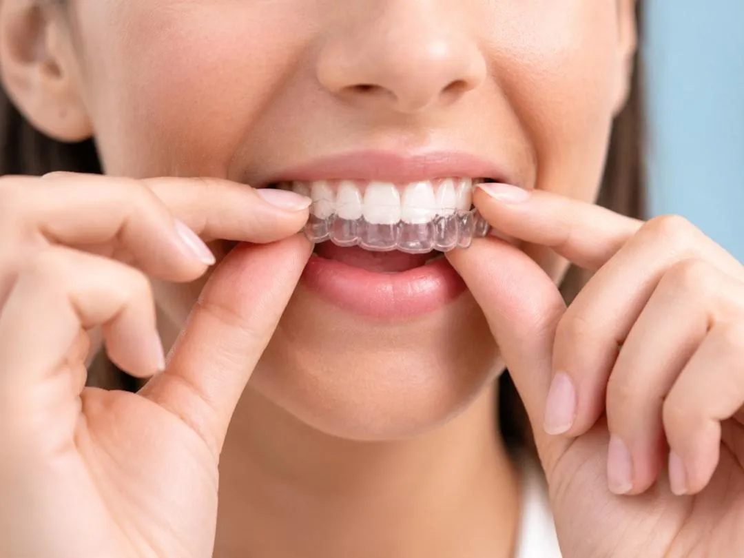 clear plastic braces