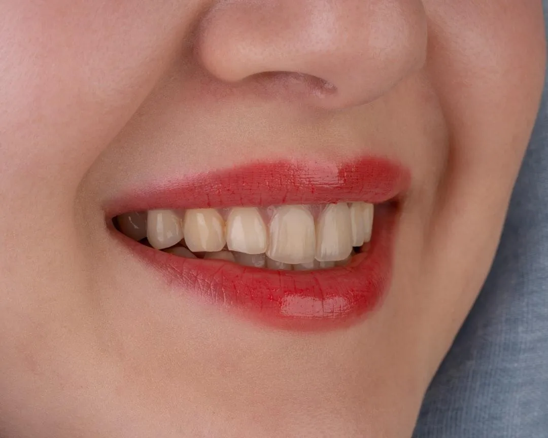 most common missing teeth